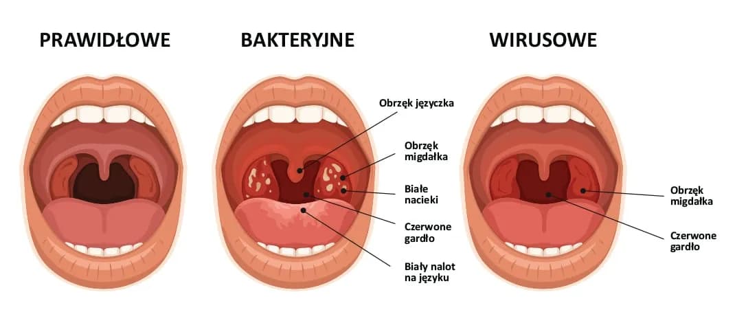 Zapalenie krtani u dziecka: objawy, leczenie i kiedy do lekarza Zapalenie krtani u dziecka: objawy, leczenie i kiedy do lekarza